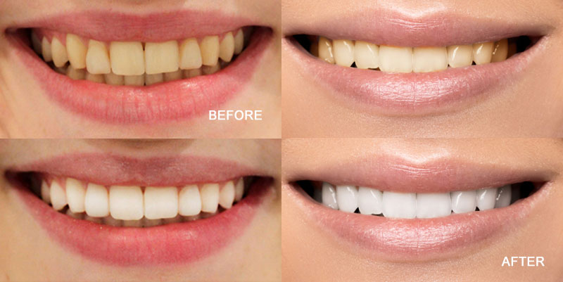Teeth Bleaching Lake Nona