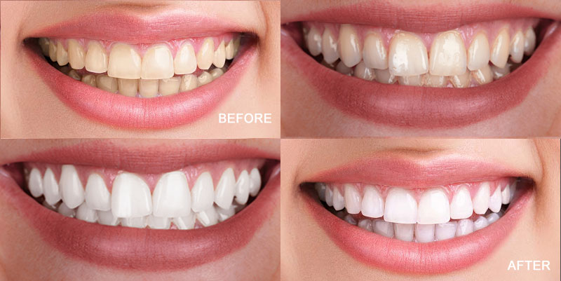 Teeth Whitening Near Lake Nona